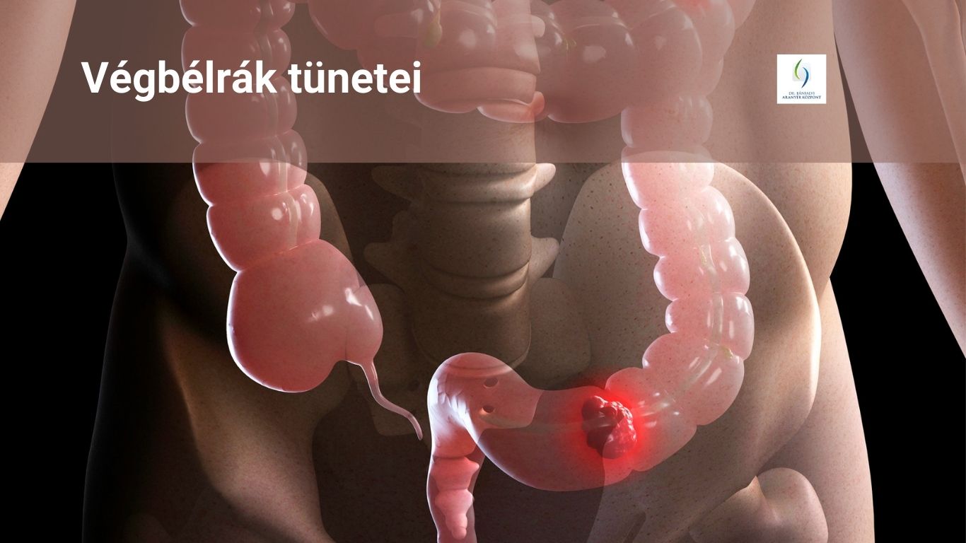 végbélrák tünetei