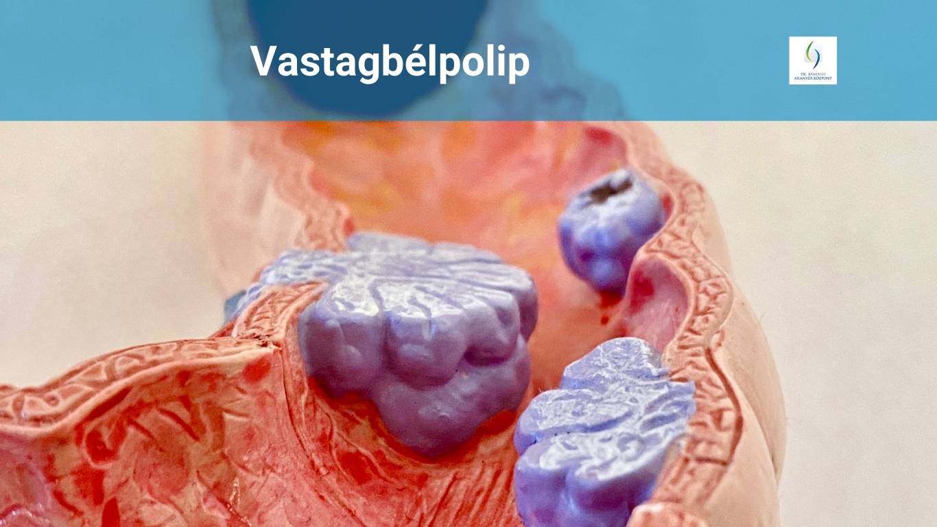 vastagbélpolip